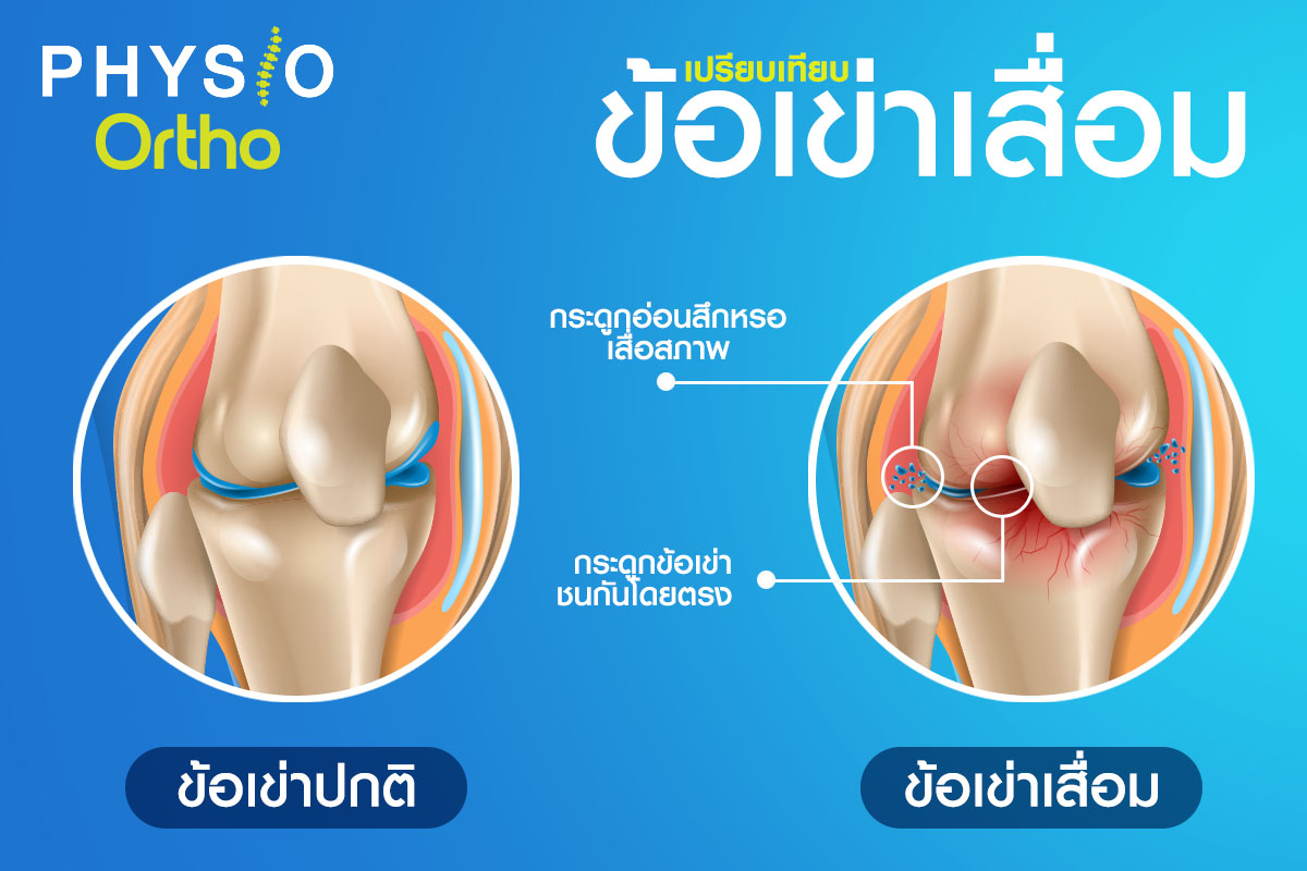 ความแตกต่างของข้อเข่าปกติและข้อเข่าเสื่อม