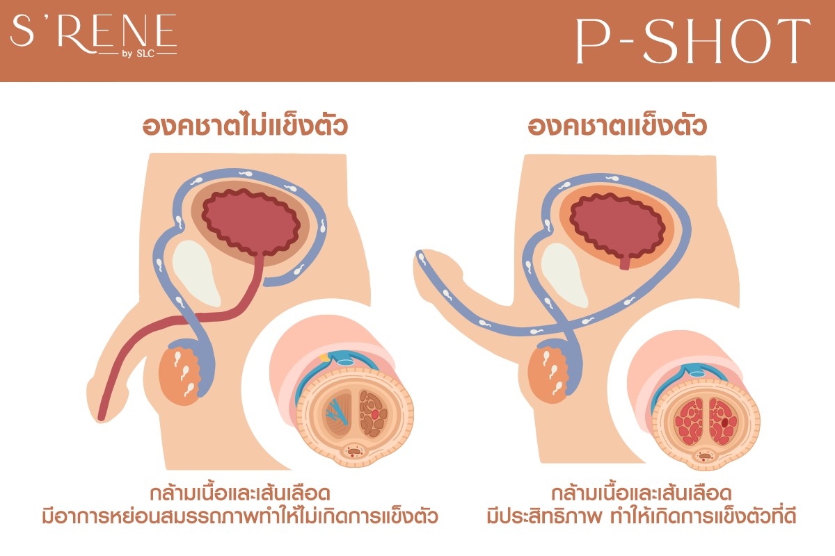 SRENE P Booster P Shot (PRP) - 6