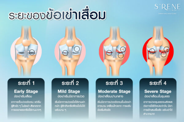 ข้อเข่าเสื่อม Knee Osteoarthritis