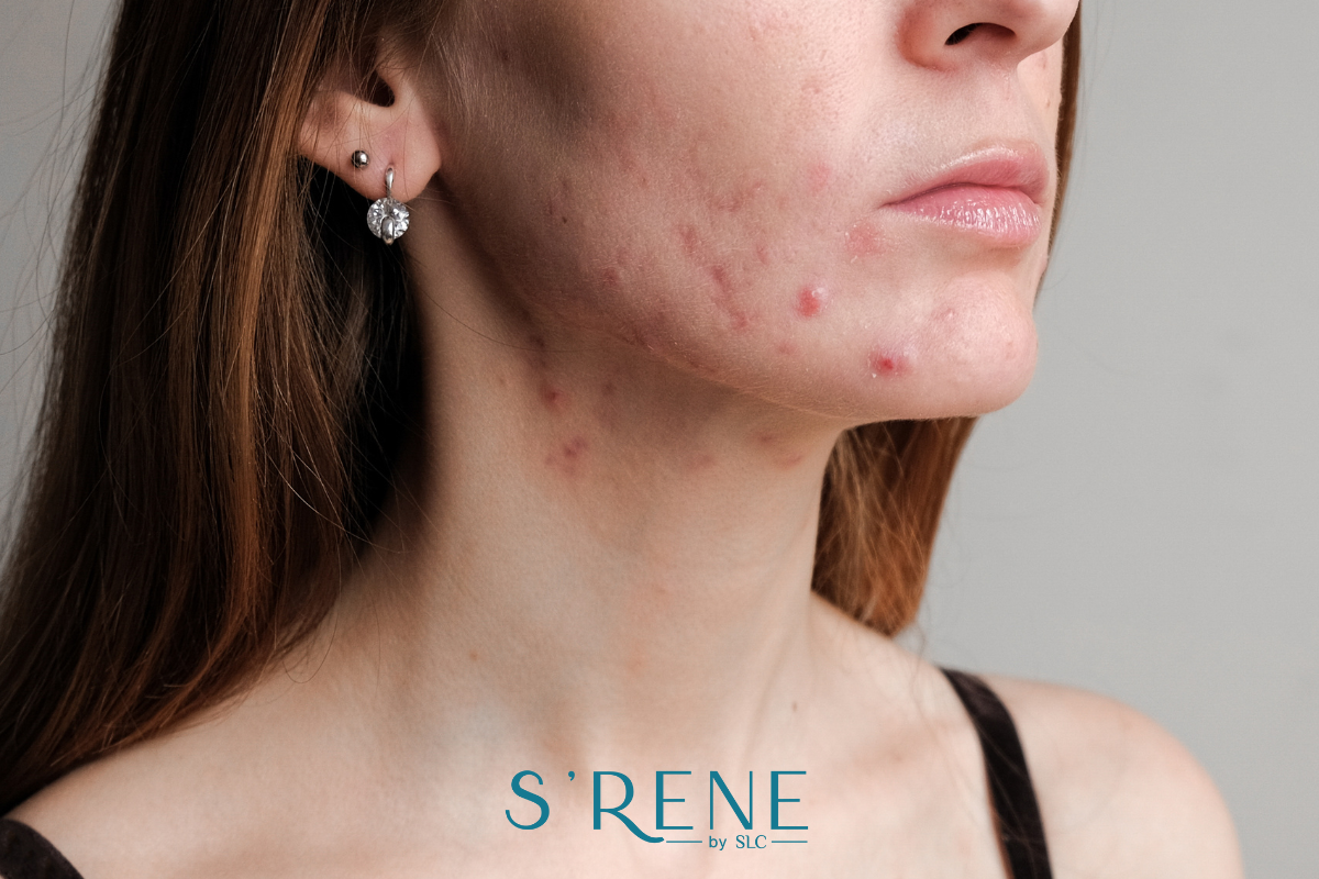 ฮอร์โมนเพศหญิง, ฮอร์โมนเพศหญิง มีอะไรบ้าง, เอสโตรเจน, โปรเจสเตอโรน, S’RENE by SLC, อารมณ์แปรปรวน, โปรแกรมปรับสมดุลฮอร์โมนเพศหญิง